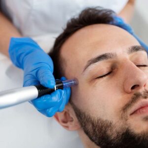 microneeding-facial-en-sevilla microneeding-facial-en-sevilla